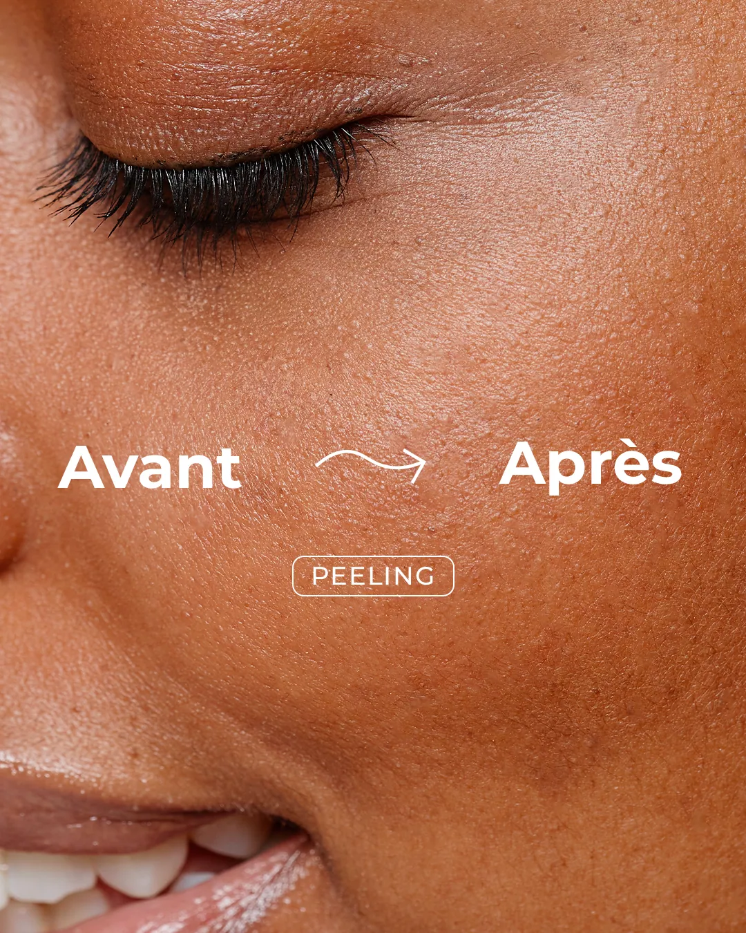 Avant / après peeling